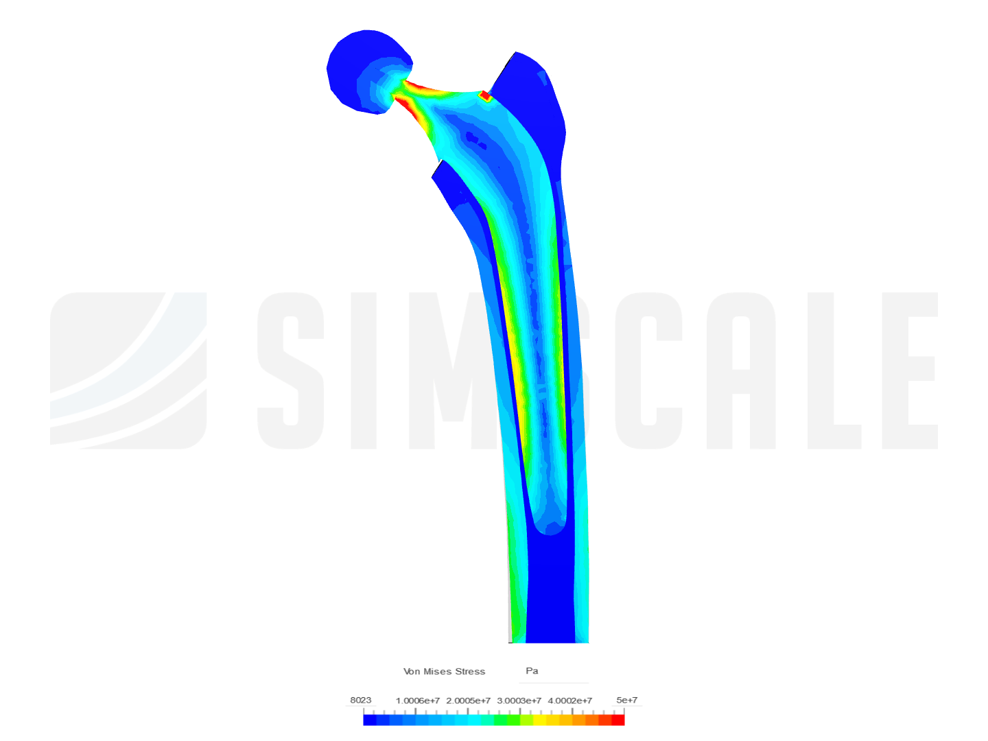 Hip Implant image