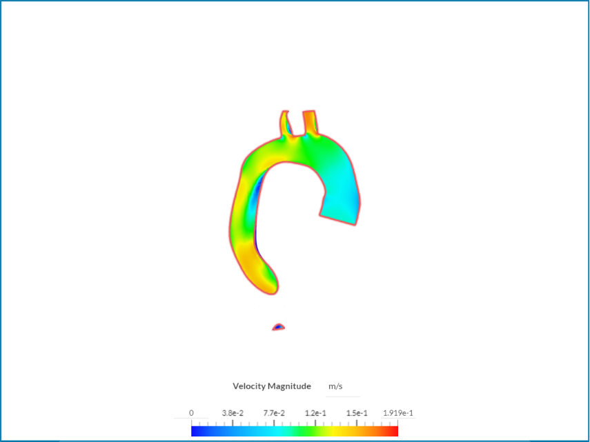 aorta_aneurizma image