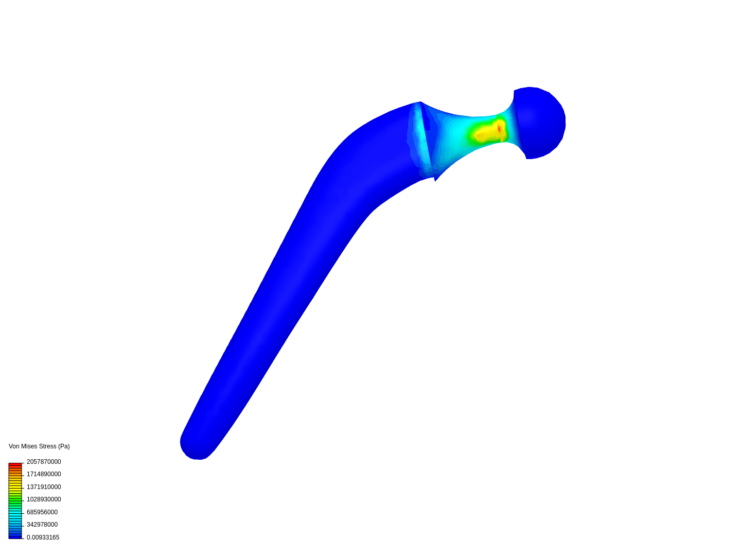 étude prothèse de hanche image