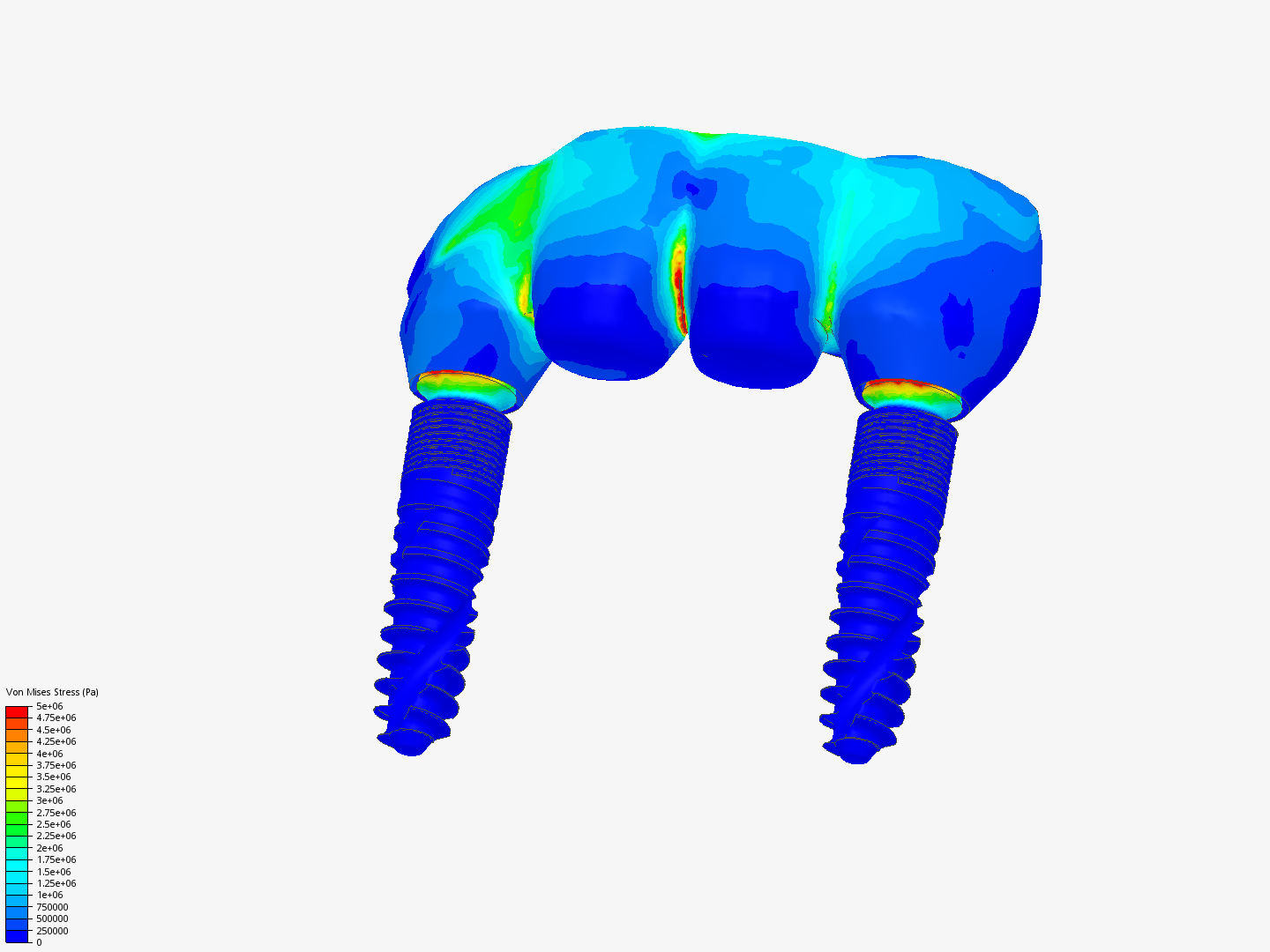 Dental Bridge image