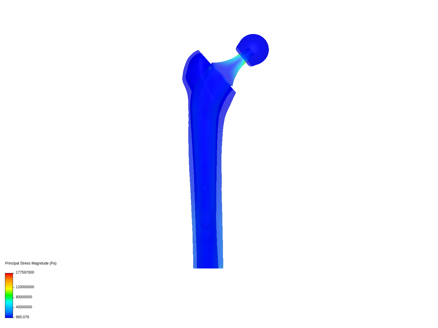 Hip Joint Prosthesis image