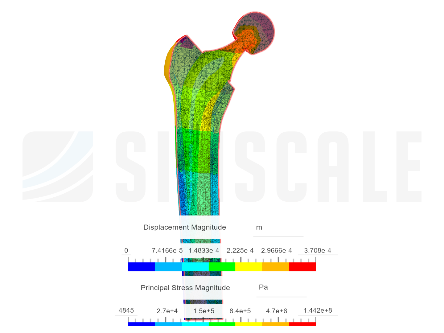 Biomechanics of Hip Joint Prosthesis image